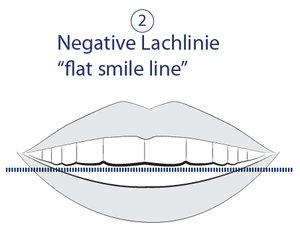 Ästhetische Zahnmedizin - Negative Lachlinie - flat smile