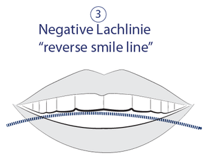 Ästhetische Zahnmedizin - Negative Lachlinie - reverse smile