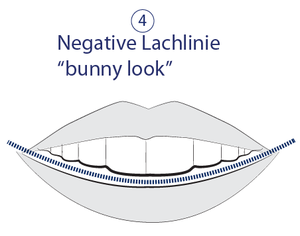 Ästhetische Zahnmedizin - Negative Lachlinie - bunny look