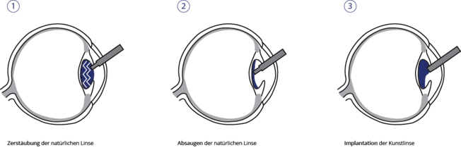 Augen Op Grauer Star Ablauf www.infomedizin.de