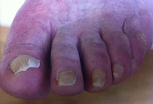 Nagelpilz