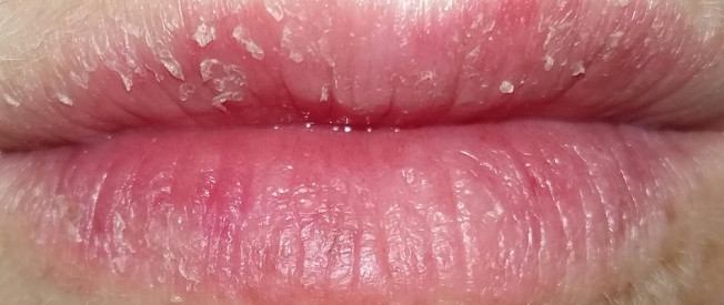 Schuppige Lippen Schuppenflechte