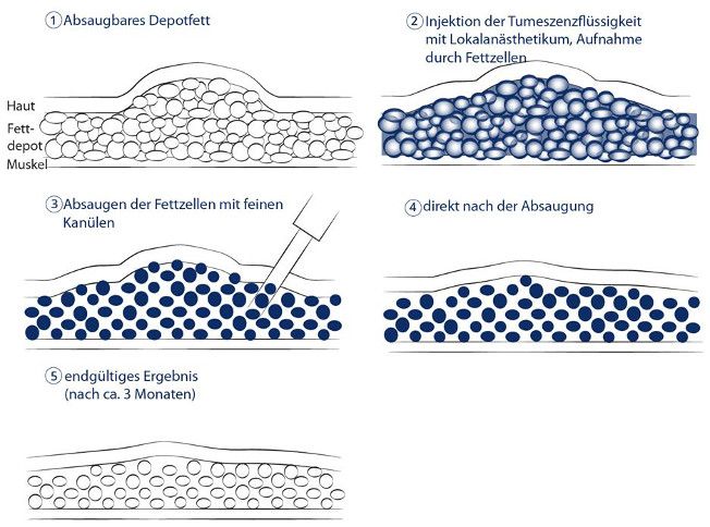 Illustration Fettabsaugung Ablauf