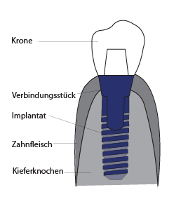 Aufbau Zahnimplantat