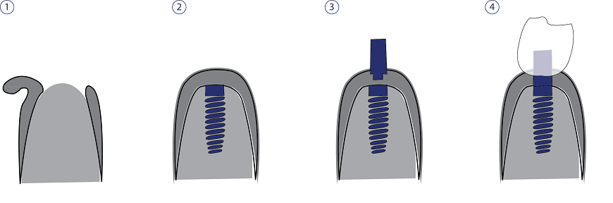 Ablauf Implantation