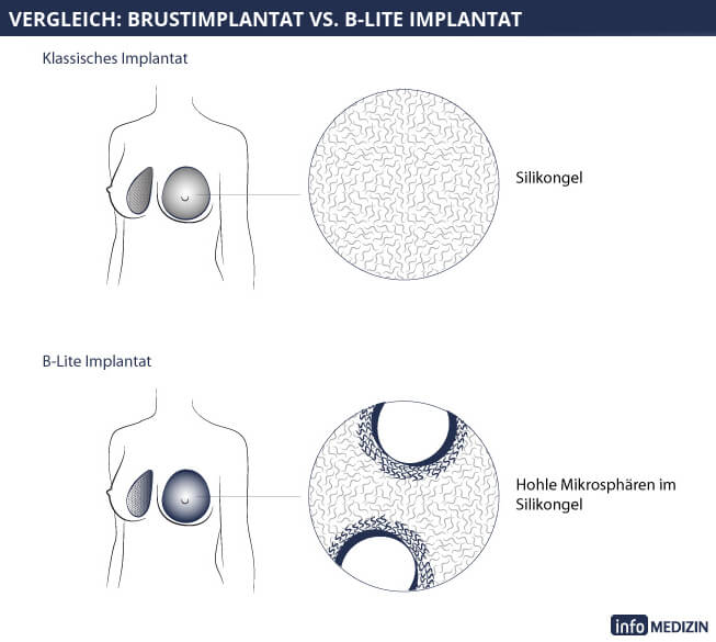 450 ml implantate bilder