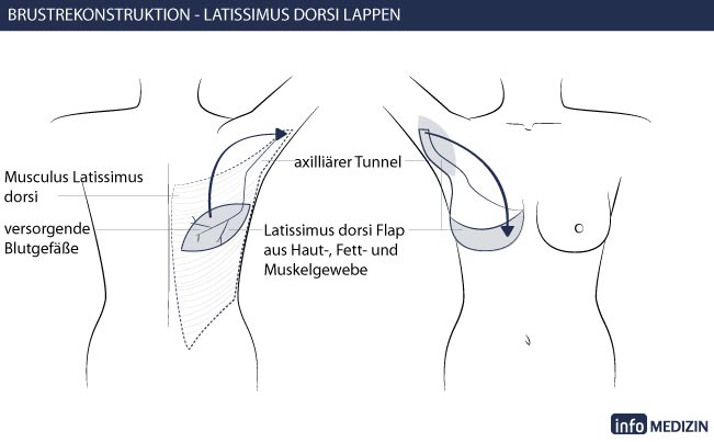 Brustrekonstruktion Eigengewebe Technik Latissimus Dorsi