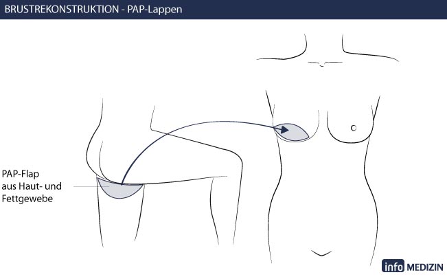 Brustrekonstruktion Eigengewebe Technik PAP Lappen