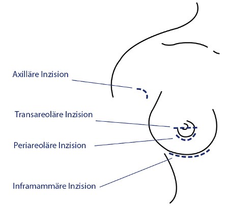 Brustvergrößerung Zugangswege Implantat