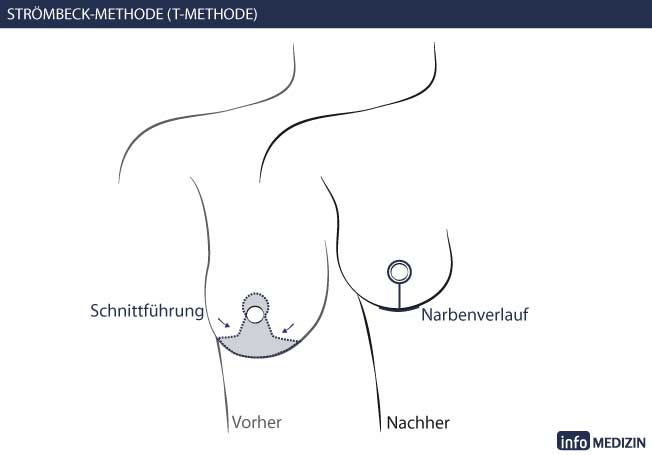 Brustverkleinerung Stroembeck