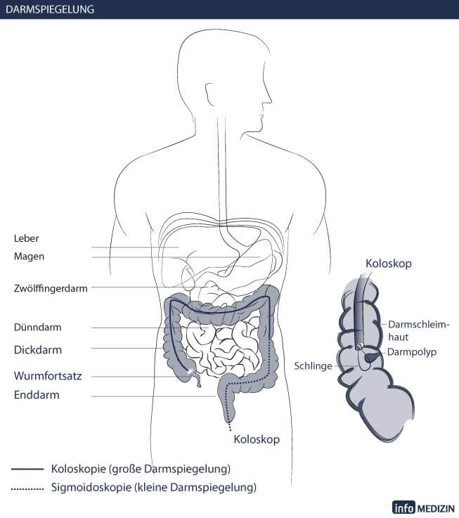 darmspiegelung illustration