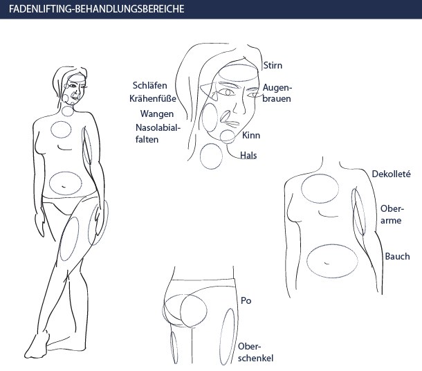 Fadenlifting Behandlungsbereiche