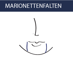 Marionettenfalten