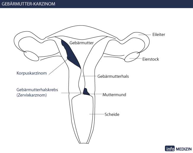 Gebärmutterhalskrebs