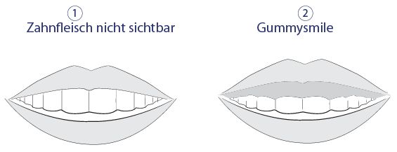 Gummysmile - Vergleich mit und ohne
