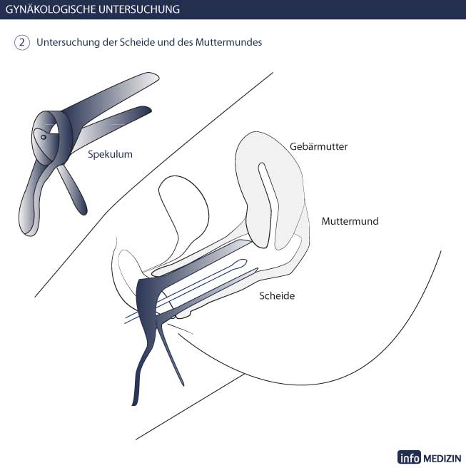 Gynäkologische Untersuchung - Spekulum