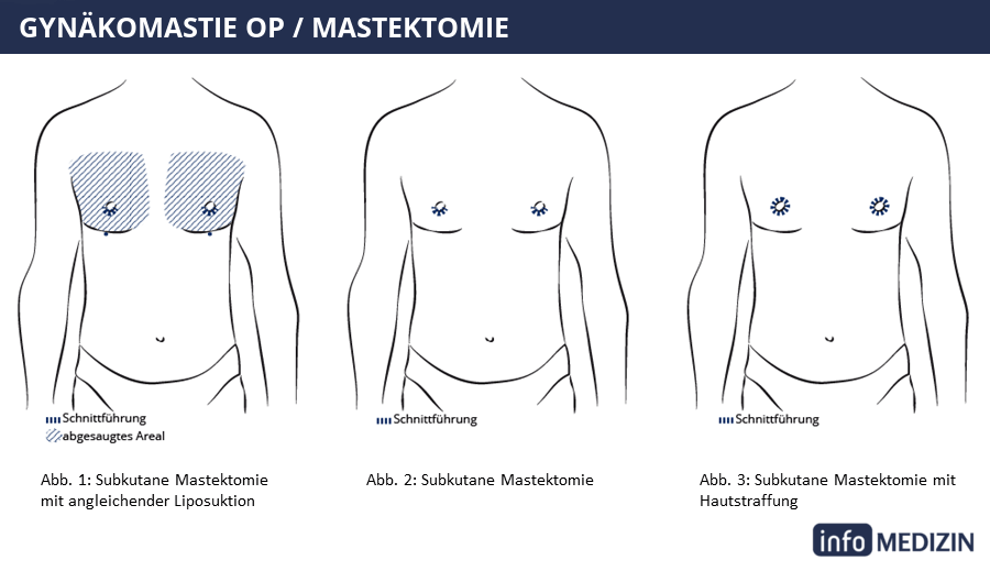 Gynäkomastie OP Techniken