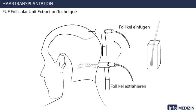 haartransplantation fue technik