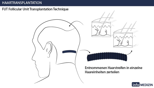 haartransplantation fut technik