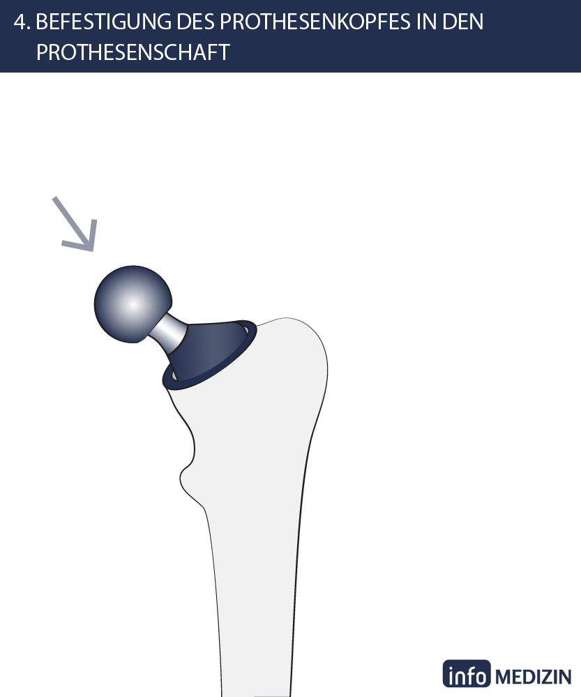 Hüft-OP Schritt 4