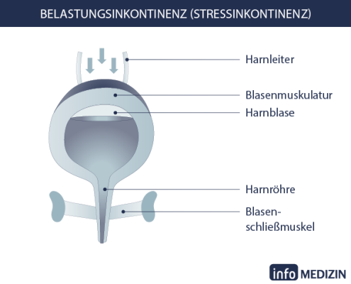 inkontinenz belastungsinkontinenz info medizin