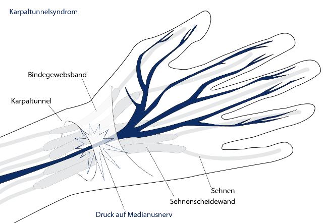 Karpaltunnelsyndrom