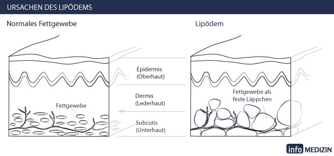 Lipödem Haut Querschnitt