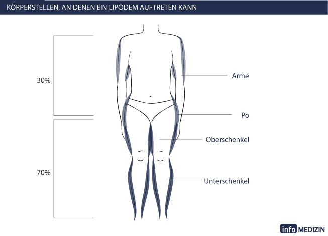 Lipödem Körperstellen