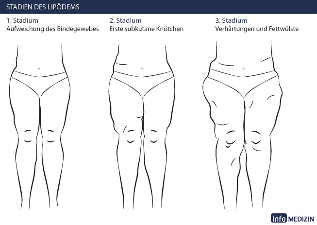 Lipödem Stadien Verlauf