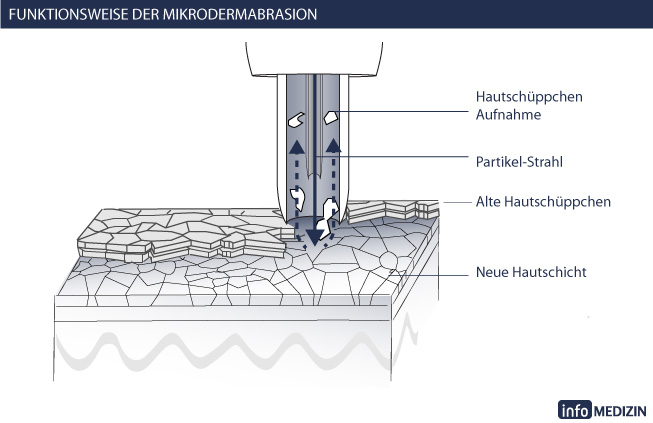 Querschnitt Ablauf Microdermabrasion