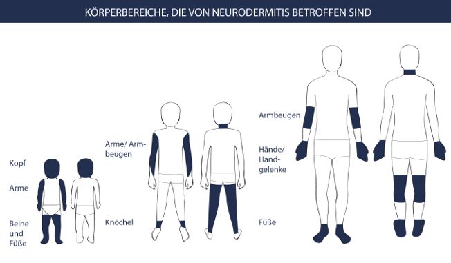 Neurodermitis Symptome Körperbereiche