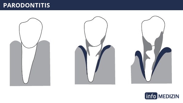 Parodontitis Überblick Krankheitsverlauf