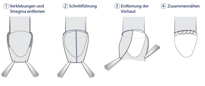 Heilung beschneidung mann Nach der