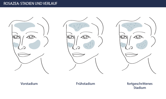 Salze rosacea schüssler bei Rosacea