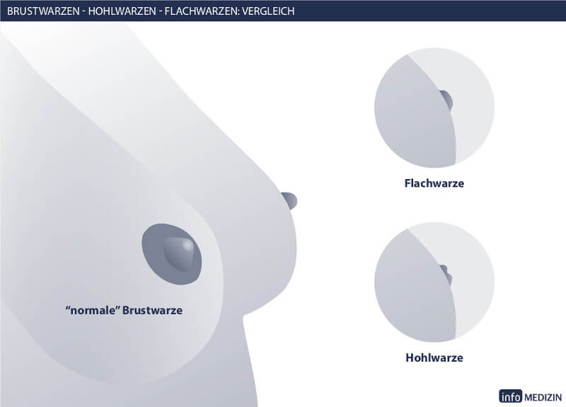 video flat invertierten brustwarze stillen