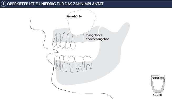 Sinuslift Schritt 1