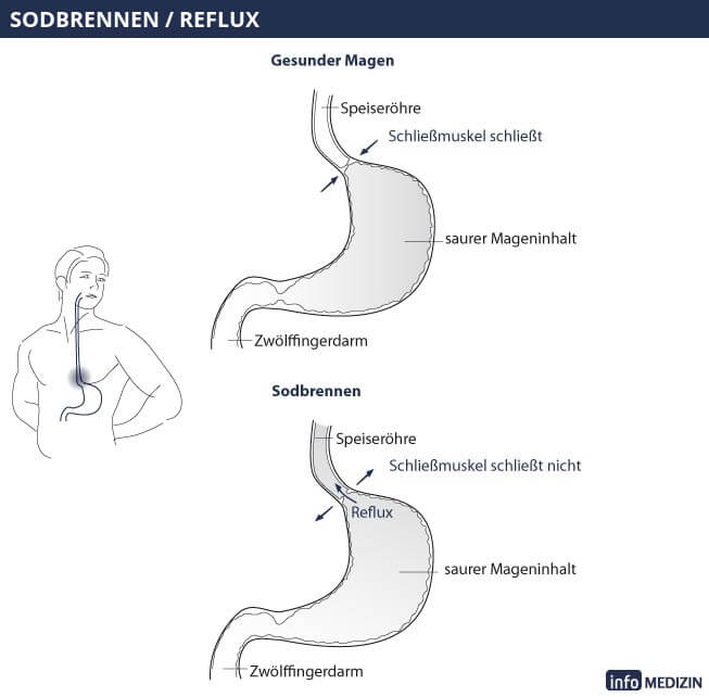 Illustration Sodbrennen Magen Querschnitt