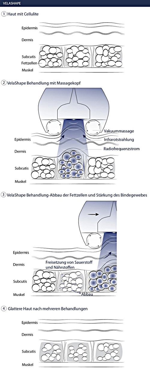 VelaShape Ablauf