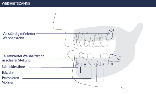 Weisheitszahn OP Position