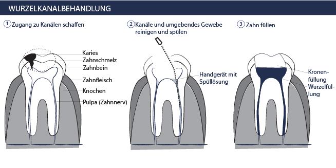 Wurzelbehandlung Ablauf