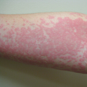 Arm mit Nesselsucht
