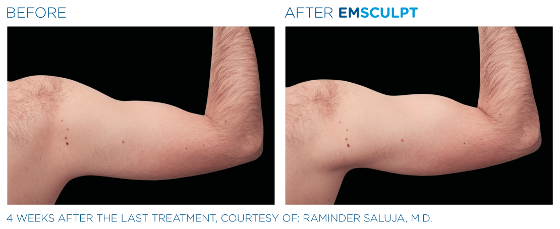 EMSCULPT® NEO Vorher Nachher Arme