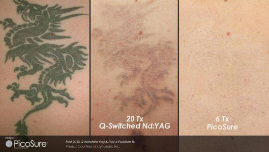Tattooentfernung Tattoo Lasern Infos Kosten Info Medizin