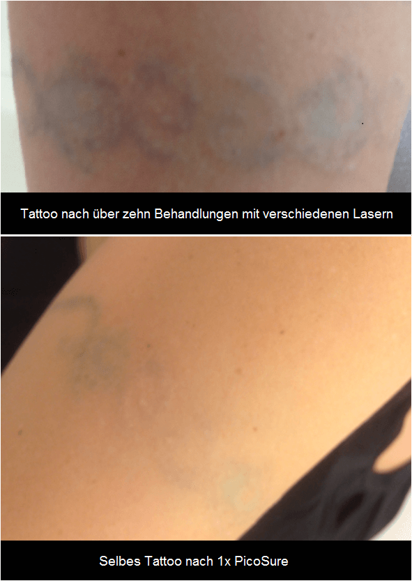 Tattooentfernung / Tattoo lasern - Infos &amp; Kosten info 